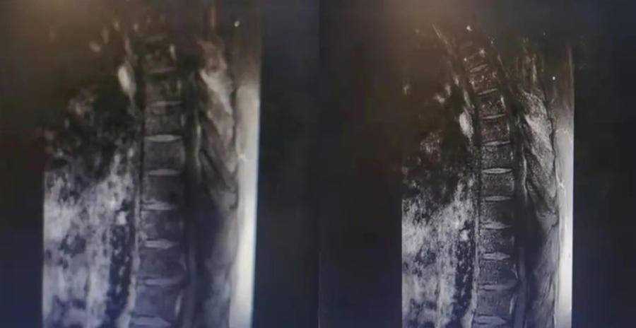 肌力从0级恢复到3级，40岁截瘫男子“站”了起来