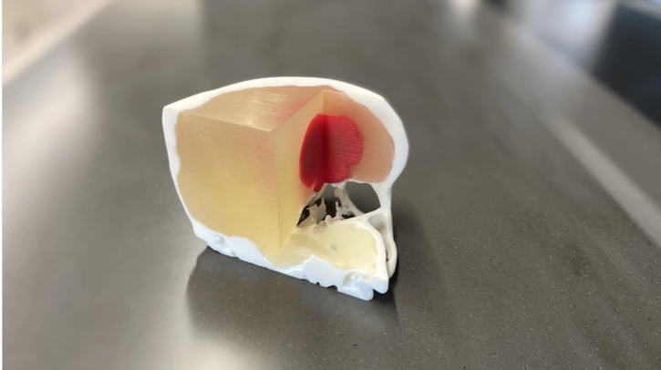 革命性的 3D 打印身体部位正在拯救澳大利亚的癌症患者